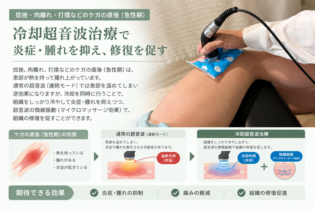捻挫・肉離れ・打撲などのケガ直後(急性期)に行う冷却超音波治療。太ももの打撲に対し、冷却材を併用しながら超音波を照射している施術写真と、通常の超音波との違いや、炎症・腫れを抑えながら組織の修復を促す冷却超音波の特徴を説明した医療情報画像。